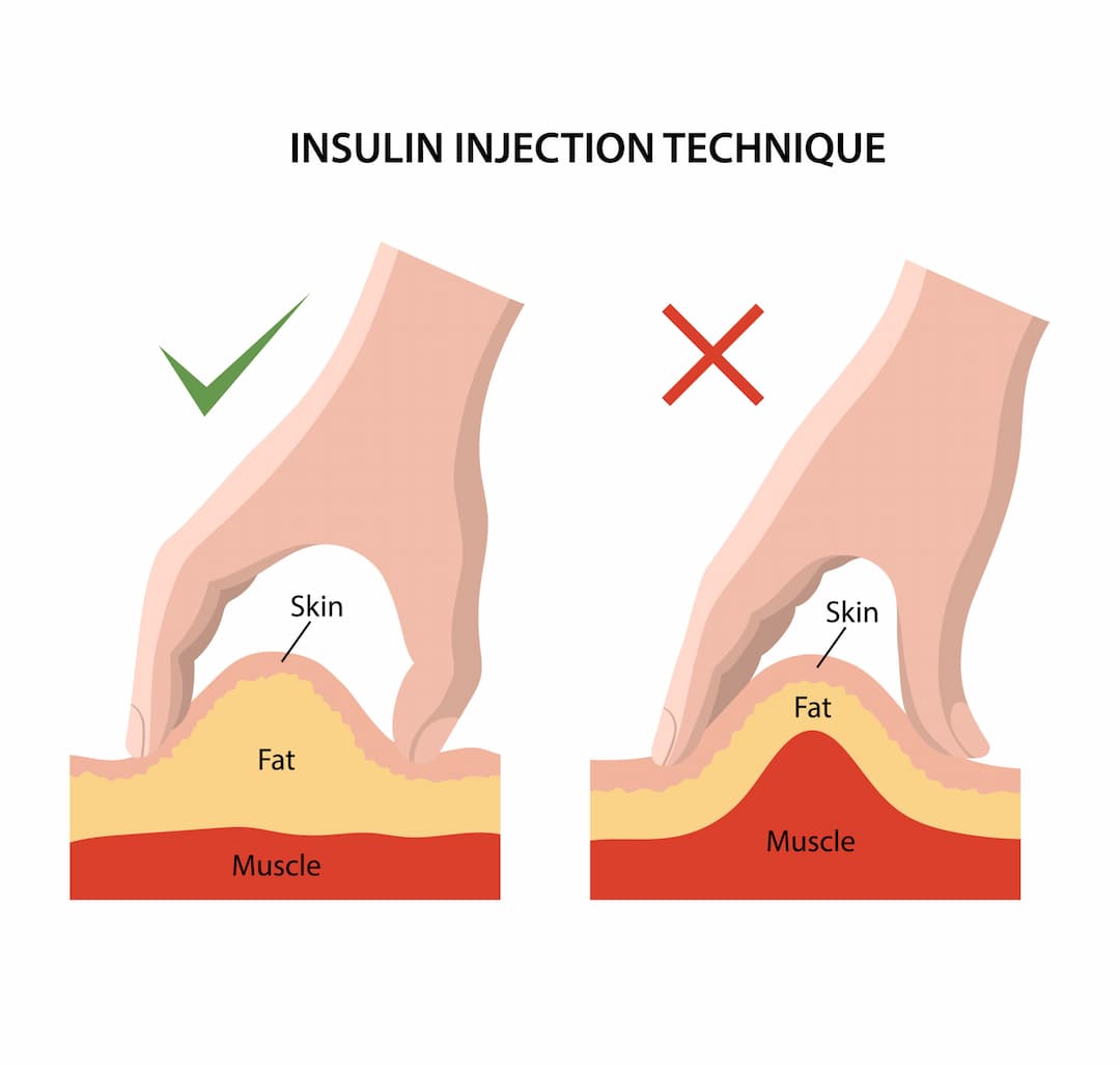 Animated image of Insulin injecting technique.