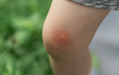 A picture of a leg with a bug bite on it