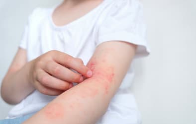 An image showing skin rashes on a child's arm.